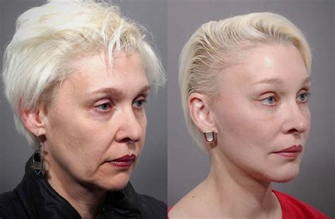 Mini Facelift Before And After Dr Andrew Jacono Mini Face Lift Face