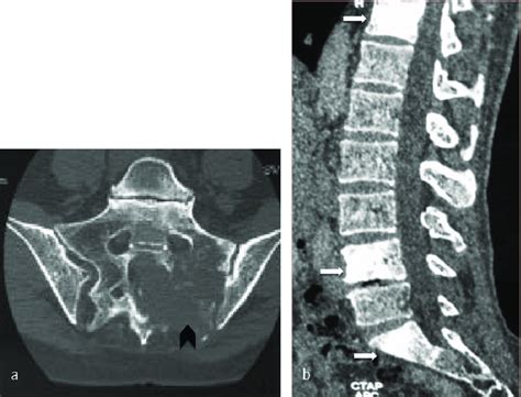 Lymphoma Of The Sacrum Axial Ct Scan Image Shows A Destructive Lesion