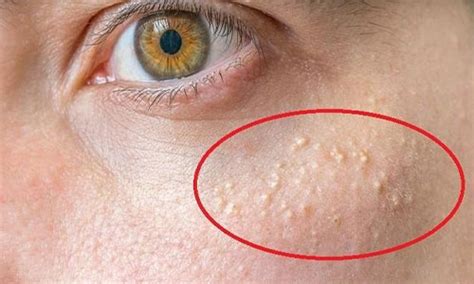 Ada beberapa cara untuk menghilangkan panu di muka tersebut. 11 Cara Memakai Minyak Zaitun Untuk Wajah Sebelum Tidur