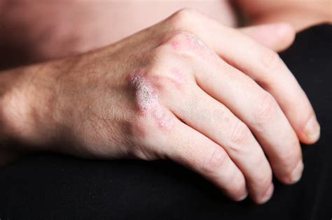 Severe Psoriasis Psoriasis On The Hand Stock Photo Image Of Doctor