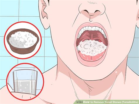 Can Tonsil Stones Kill You Tonsil Stones Removal Tips