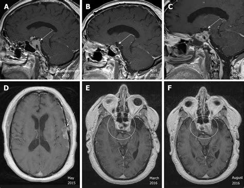 Mri Brain Tumor Pituitary