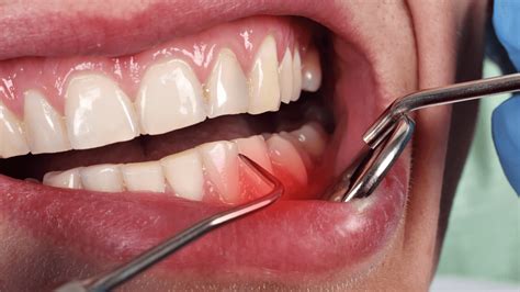 Zahnfleischentz Ndung Symptome Ursachen Behandlung Rbb