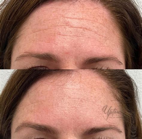 We Can Reduce Forehead Wrinkles In Northglenn Co