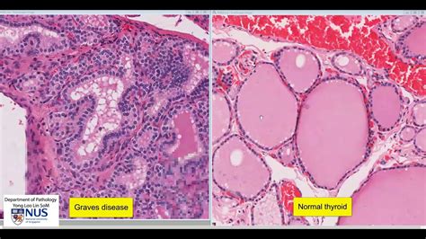 Thyroid Graves Disease Micrscopy Talking Slide Youtube