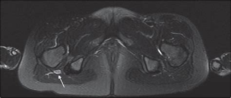 Pediatric Sciatic Neuropathy Presenting As Painful Leg A Case Report