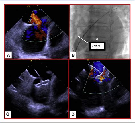 Figure 2 From Successful Transcatheter Closure Of A Rare Malaligned