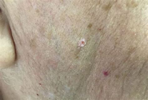 Dermdx Lesion On The Cheek From Shaving Dermatology Advisor