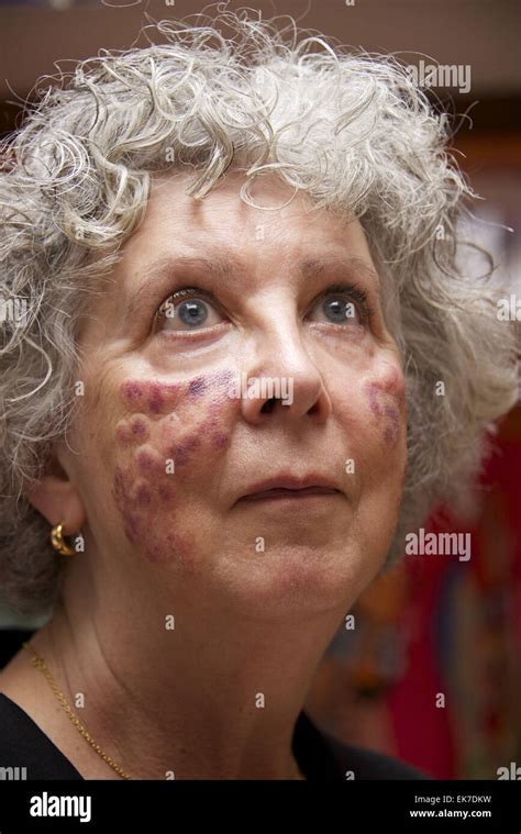 Laser Burn Skin Hi Res Stock Photography And Images Alamy