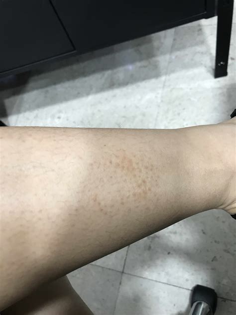 How Effective Is Cryotherapy For Hyperpigmentation On Legs Photo Human
