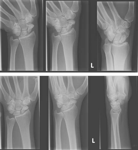 The Malerich Procedure Distal Scaphoid Resection Musculoskeletal Key