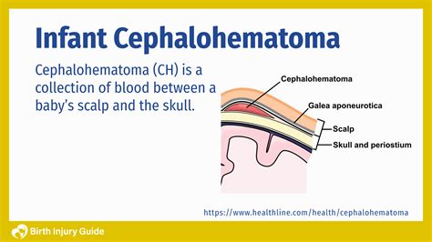 Infant Cephalohematoma Causes Treatment And Prevention