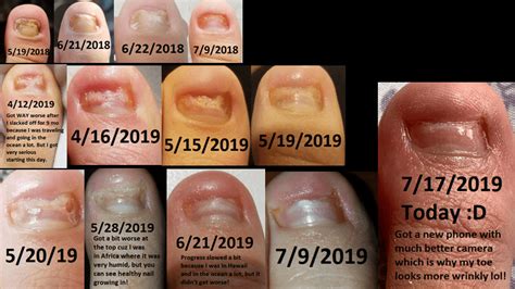 Toenail Fungus Vinegar Before And After Nail Treatment Progression