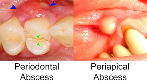 Symptoms Of Tooth Abscess Infection
