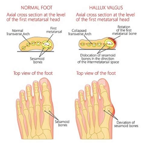 What Is Sesamoiditis Foot And Ankle Center Of Illinois Podiatrists