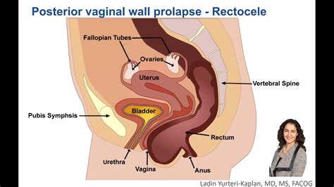 Pelvic Organ Prolapse And Posterior Pelvic Angle Is Pelvic Alignment Hot Sex Picture