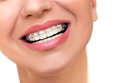 Diferencias Entre Ortodoncia Tradicional Y Método Invisible Clínica Dental Fañabe Plaza