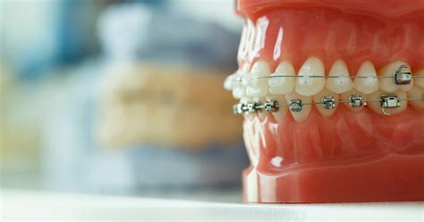 Types Of Braces And Appliances — Marysville Orthodontics Braces Invisalign Smokey Point