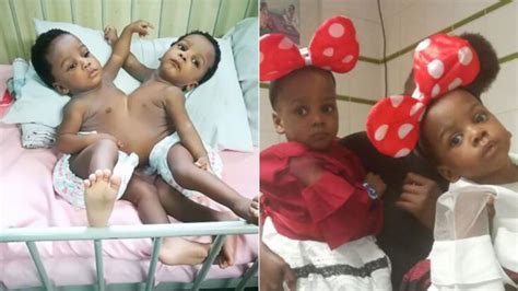 Conjoined Twins Successfully Separated By 78 Member Team In Nigeria