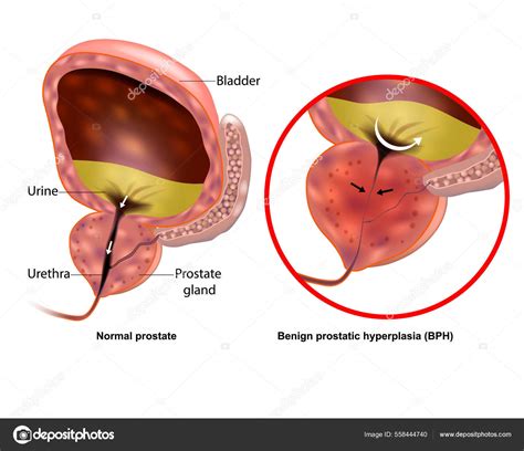 Medical Illustration Showing Benign Prostatic Hyperplasia Bph And
