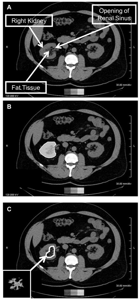 Abdominal Computed Tomography Scans Demonstrating The Renal Sinus Fat