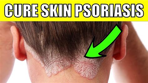 Cure Scalp Psoriasis Permanently With These 7 Natural Remedies Youtube