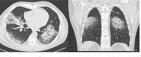 Figure 1 From The Development Of Pulmonary Aspergillosis And Its
