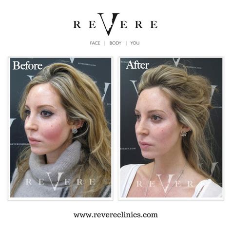 Nonetheless, ' lip fillers gone wrong' is on the rise because there is too much social pressure, too much social media influence and too much lip filler around you. Pin on Treatments at Revere