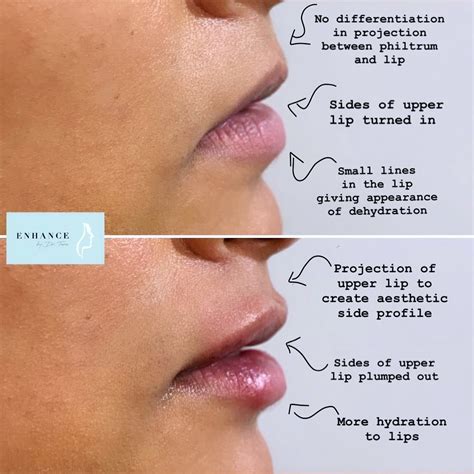 Dʀ Tᴀʀᴀ On Instagram “a Natural Looking Lip Enhancement Using 1ml Of
