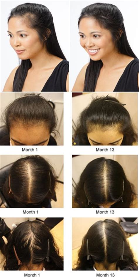 Top Image Causes Hair Loss Women Thptnganamst Edu Vn