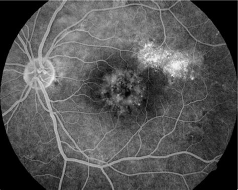 Fundus Fluorescein Angiography Image Of A Chronic Case Of Central
