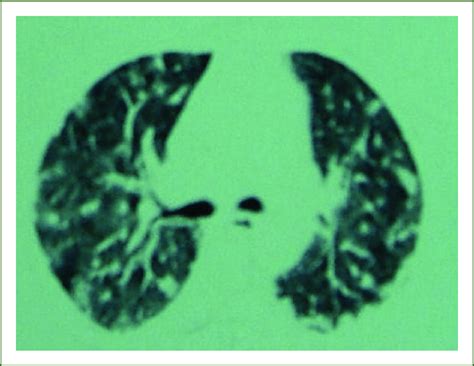 Chest Computed Tomography Showed Tickened Interlobular Septa And