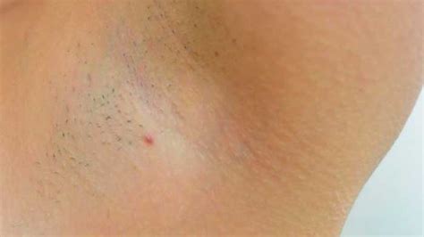 Before removing ingrown hair in your underarms, you should first treat the inflammation until it is safe to extract the. Ingrown Armpit Hair, Lymph Node, Pictures, Lump, How to ...