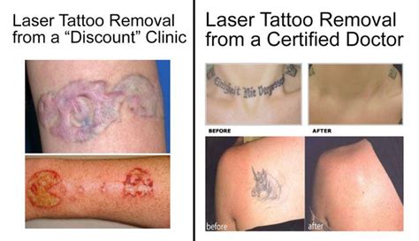 Is Laser Tattoo Removal Really Safe The Skiny Laser Tattoo Removal