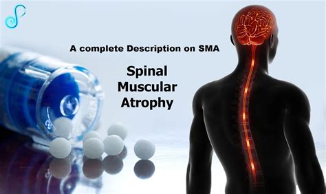 What Actually Spinal Muscular Atrophy Is Sma ~ Sma Families
