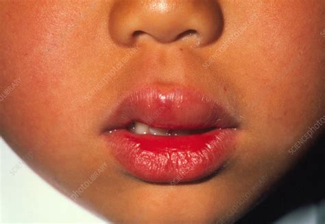 Are Swollen Lips A Sign Of Allergic Reaction