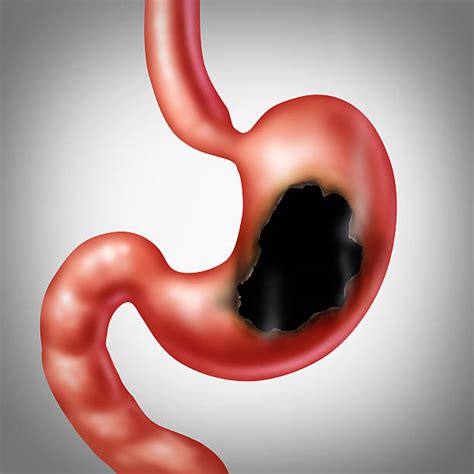 Stomach Ulcer Stock Photos Pictures And Royalty Free Images Istock