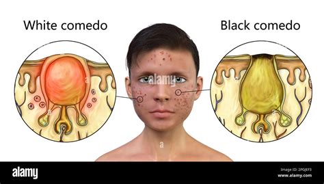 Acne Vulgaris On A Teenage Boys Face And Close Up View Of Black And