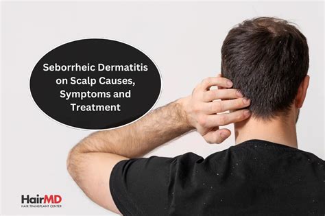 Seborrheic Dermatitis Causes Symptoms And Treatment