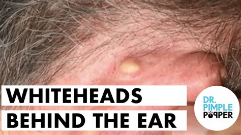 Whiteheads Behind The Ears Extracted Dr Pimple Popper