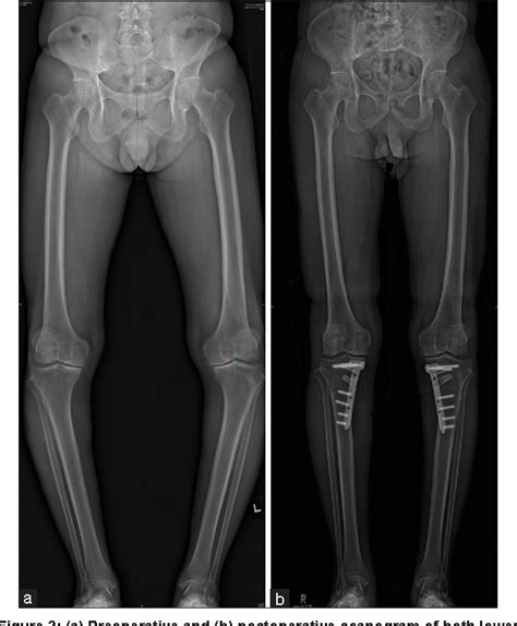 Figure 2 From Role Of High Tibial Osteotomy In Cartilage Regeneration