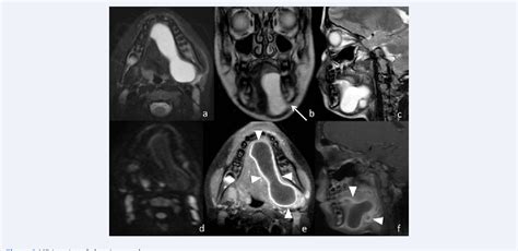 Figure 2 From A Rare Case Of Plunging Infected Ranula Mri Diagnosis