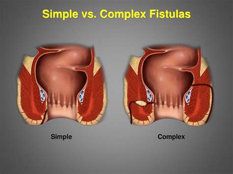 PPT Internal And Perianal Fistulas Current Treatment Approach PowerPoint Presentation ID