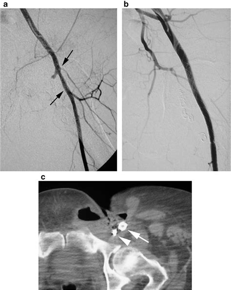 Figure 2 From Endovascular Graft Placement For Femoral Artery Erosion