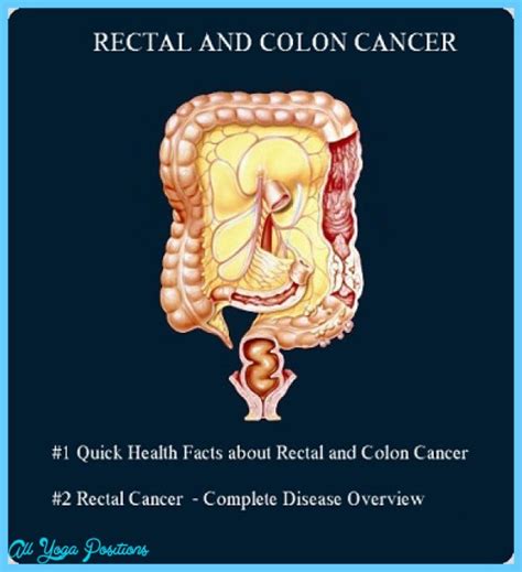 Colon And Rectal Cancer