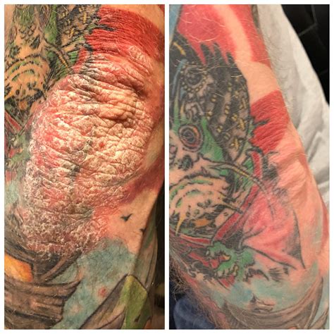 Aos portadores da psoríase, é relevante saber qual a categoria da psoríase que disponibiliza para que o tratamento seja certeiro. Another Stelara update 10 weeks in. : Psoriasis