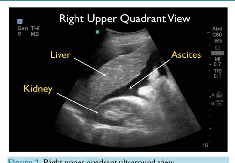 Figure 2 From Ultrasound For Detection Of Ascites And For Guidance Of