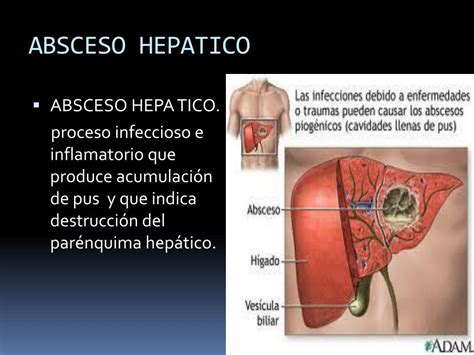 Ppt Absceso Hepatico Powerpoint Presentation Free Download Id2121725