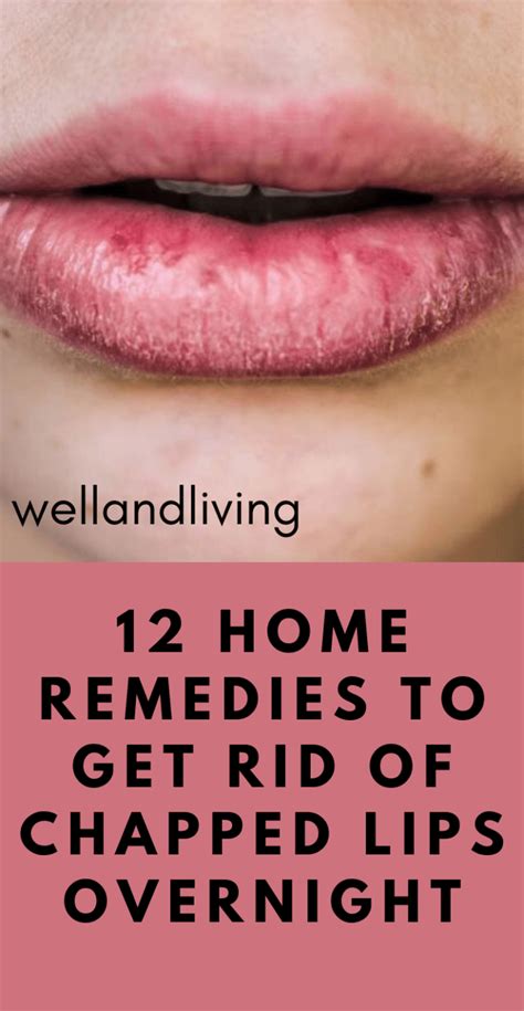 12 Home Remedies To Get Rid Of Chapped Lips Overnight Dry Lips Remedy