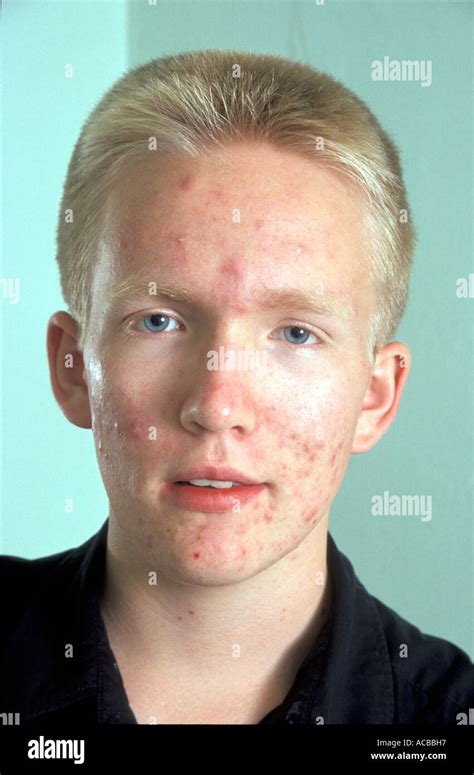 Portrait Blonde Teenage Boy With Acne On Face Stock Photo Royalty Free